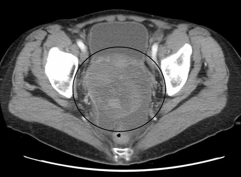 Large ovarian cancer detected via CT scan. (Wikipedia pic)